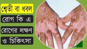 শ্বেতী রোগ কি কি কারণে হয়? কখন শ্বেতী রোগ বেড়ে যায়, প্রতিকার কি?