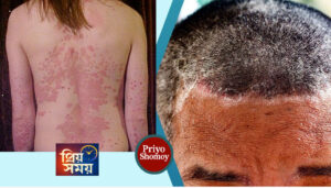 সোরিয়াসিস ও স্ক্যাল্প সোরিয়াসিস—কারণ, প্রতিকার এবং চিকিৎসায় হাকীম মিজানুর রহমানের ভূমিকা